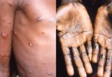 Detectan en la Argentina el primer caso de la viruela del mono más agresiva: cómo prevenirla